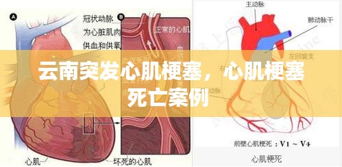 云南突發(fā)心肌梗塞，心肌梗塞死亡案例 