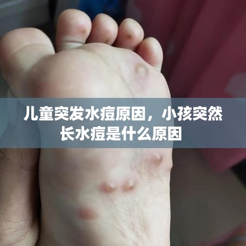 兒童突發(fā)水痘原因，小孩突然長(zhǎng)水痘是什么原因 