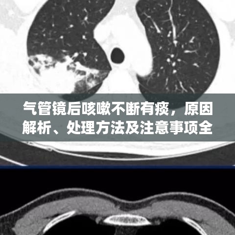 氣管鏡后咳嗽不斷有痰，原因解析、處理方法及注意事項全攻略