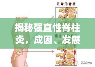 揭秘強(qiáng)直性脊柱炎，成因、發(fā)展與突發(fā)性的真相解析