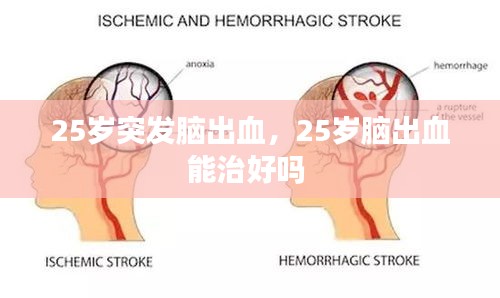 25歲突發(fā)腦出血，25歲腦出血能治好嗎 