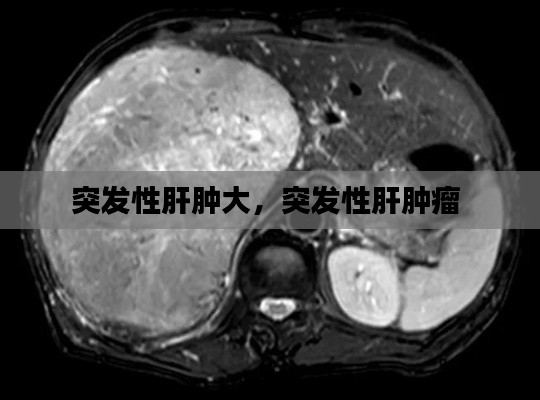 突發(fā)性肝腫大，突發(fā)性肝腫瘤 